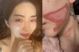 Kwon Mina เปิดใจเรื่องไฟไหม้ที่ผิวหนังหลังทำเลเซอร์ 😢