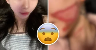 น่าเศร้า! Kwon Mina เผยประสบการณ์เลเซอร์สุดสยอง 😢