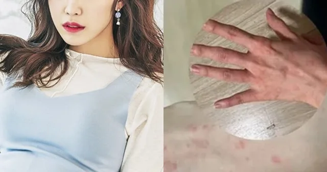 ช็อก! Jeon Hyosung เผยภาพผื่นแดงเต็มตัว พร้อมสารภาพป่วยเรื้อรังนาน 4 เดือน!