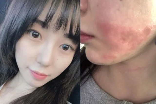 Kwon Mina อัปเดตอาการบาดเจ็บแผลไหม้ระดับสอง พร้อมเผยความกังวลเรื่องการฟื้นตัวที่ช้าลง